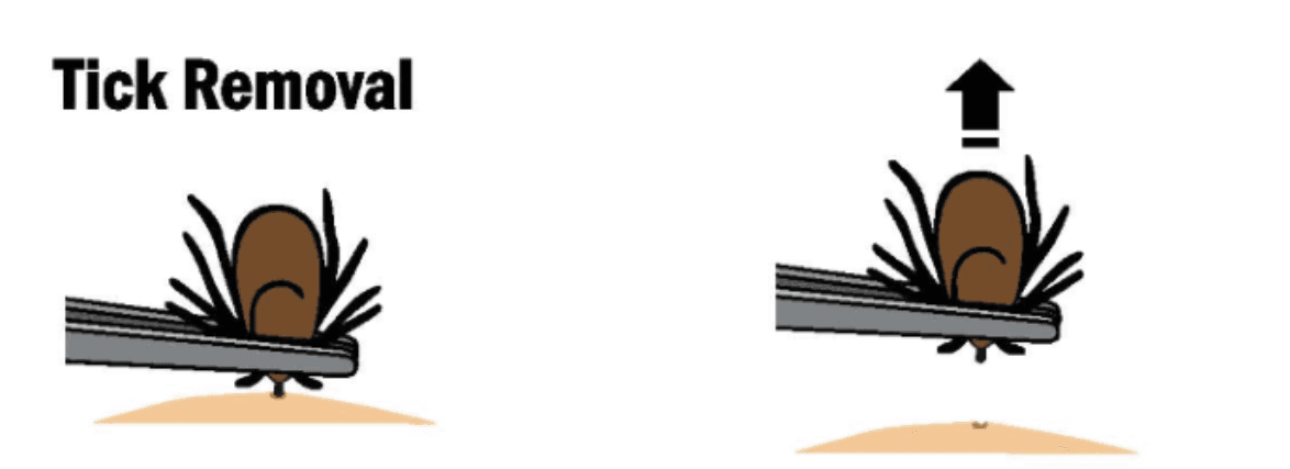 Tick Removal demonstration using a tweezer to pull out a tick.